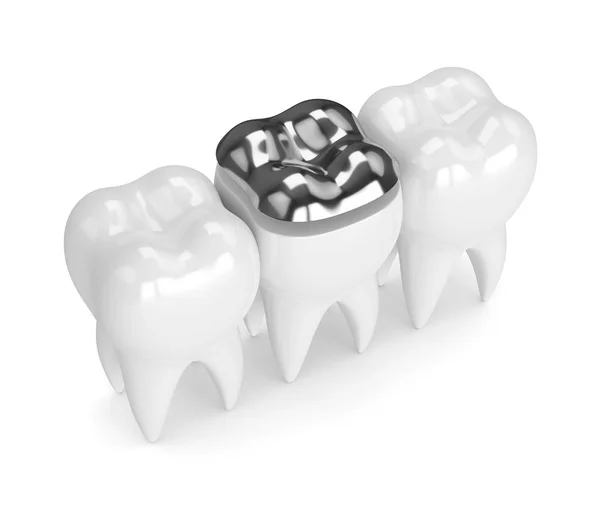 Rendement 3d des dents avec remplissage d'amalgames dentaires — Photo