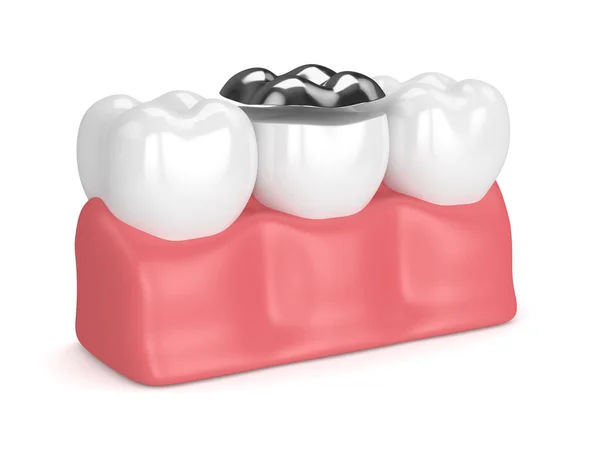 3d renderização de dentes com enchimento de amálgama onlay dental — Fotografia de Stock