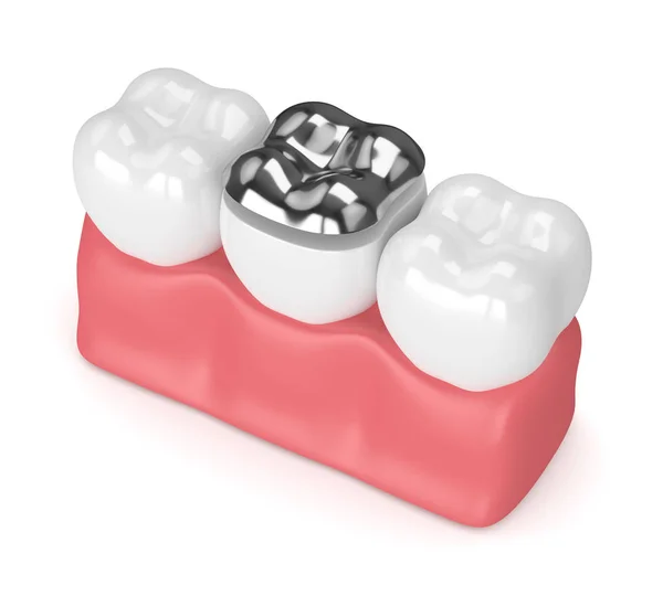3d renderização de dentes com enchimento de amálgama onlay dental — Fotografia de Stock
