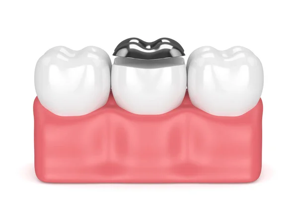 3d render of teeth with dental onlay amalgam filling — Stock Photo, Image