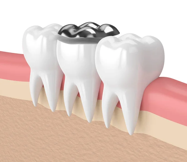 3d render of teeth with dental onlay amalgam filling — Stock Photo, Image