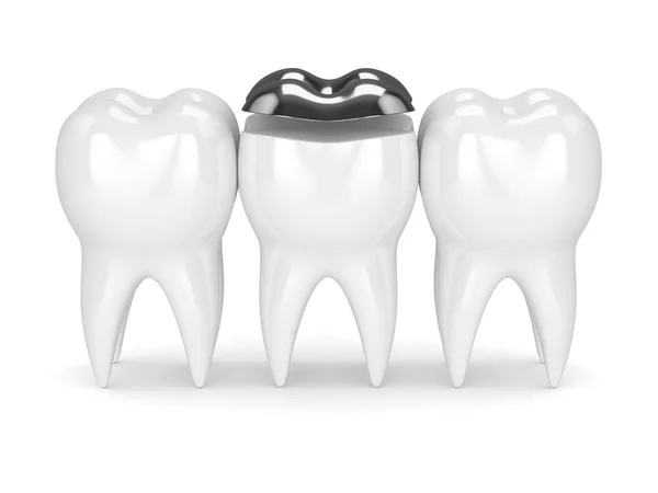歯科上張りアマルガム詰物と歯の 3 d レンダリング — ストック写真