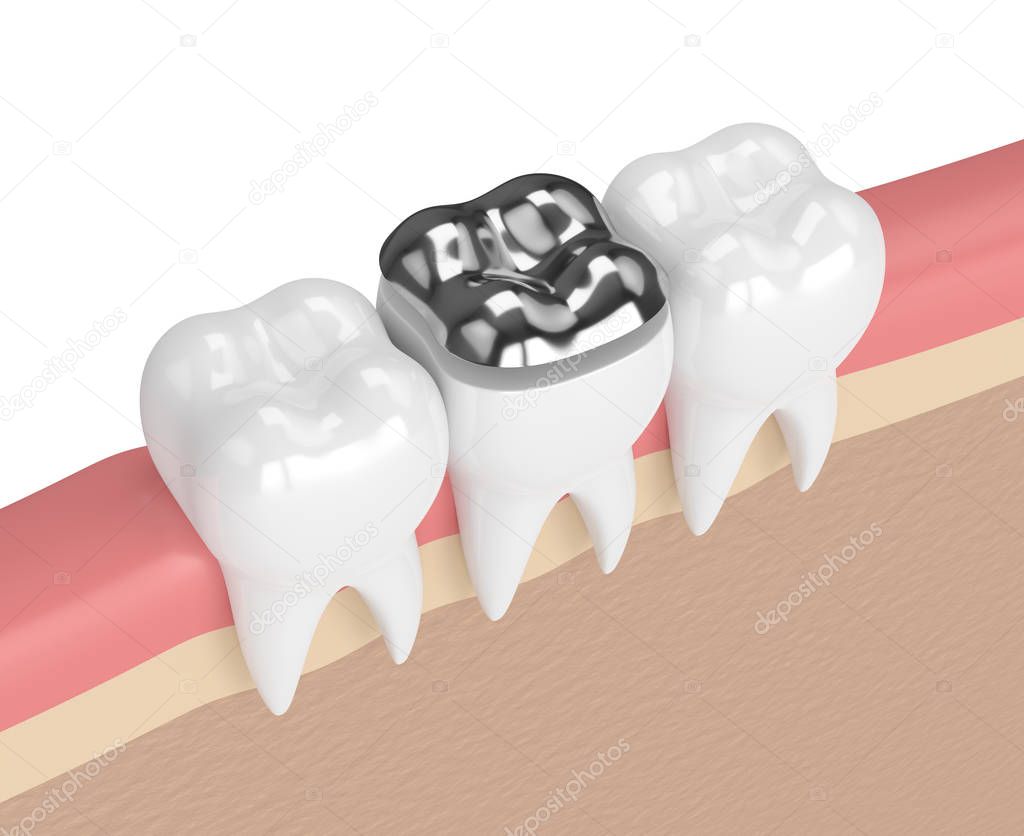 3d render of teeth with dental onlay amalgam filling