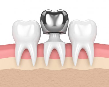 diş diş taç amalgam dolgu ile 3D render
