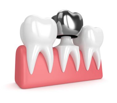 diş diş taç amalgam dolgu ile 3D render