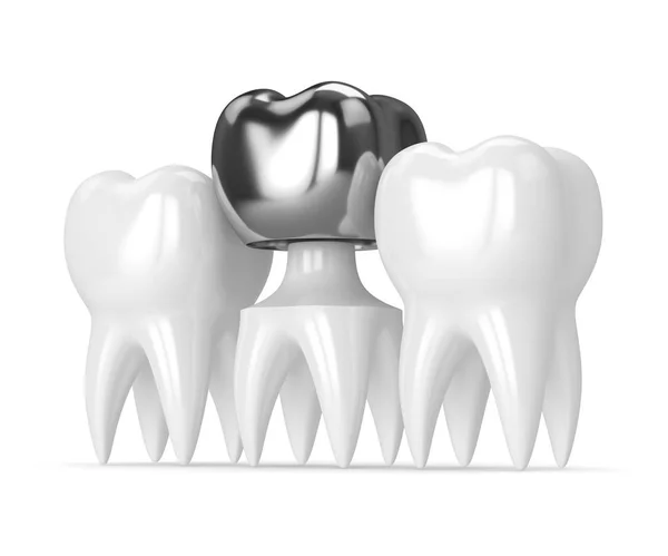 3d renderização de dentes com preenchimento amálgama coroa dental — Fotografia de Stock