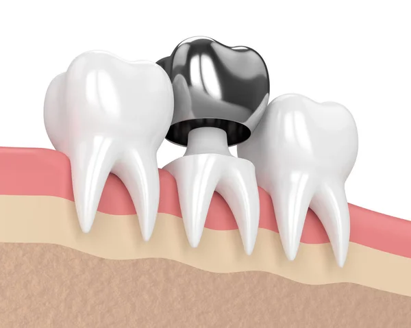 3D render van tanden met kroon tandheelkundige amalgaam vulling — Stockfoto