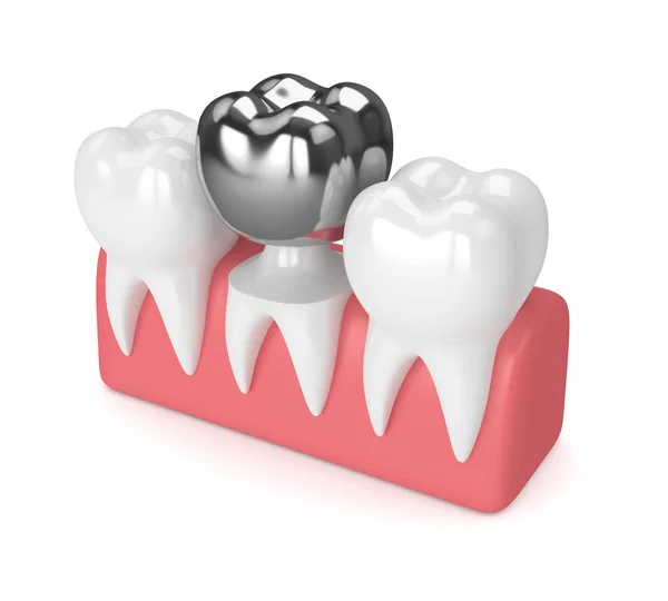 치과 크라운 아 말 감 충전 치아의 3d 렌더링 — 스톡 사진