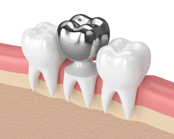 Odwzorowania 3D zębów z wypełnienia amalgamatu korony dentystyczne — Zdjęcie stockowe