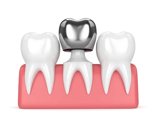 3D-Darstellung der Zähne mit Zahnkrone-Amalgamfüllung — Stockfoto