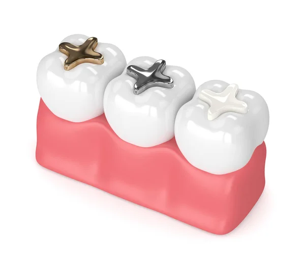 3d render of teeth with different types of dental filling — Stock Photo, Image