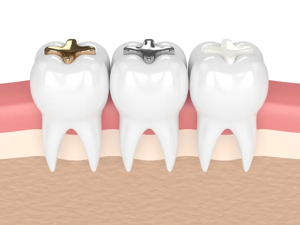 3d render of teeth with different types of dental filling — Stock Photo, Image