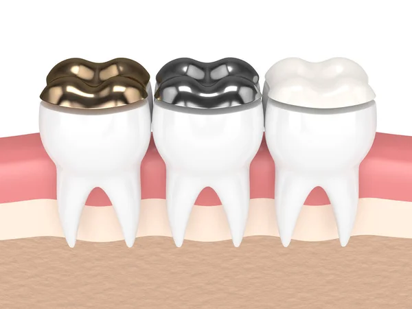 3D render a fogak, a különböző típusú fogászati töltés — Stock Fotó