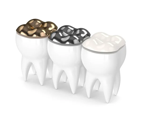さまざまな種類の歯の充填と歯の 3 d レンダリング — ストック写真