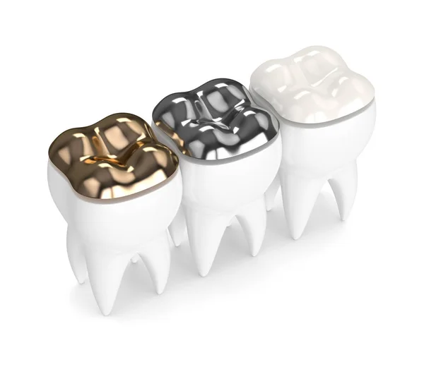3d renderizado de dientes con diferentes tipos de relleno dental — Foto de Stock