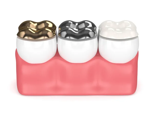 3D render tänder med olika typer av tandvård fyllning — Stockfoto