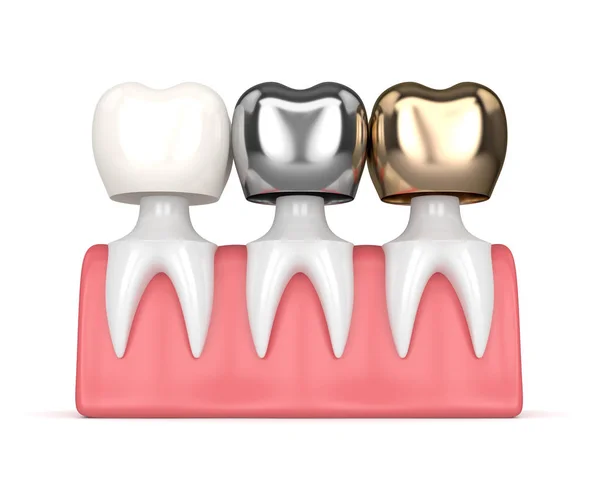 Odwzorowania 3D zębów z różnego rodzaju korony dentystyczne — Zdjęcie stockowe