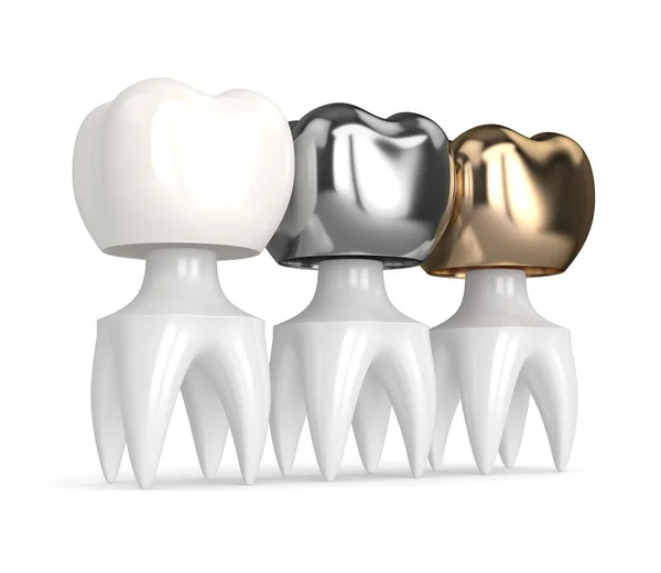 3d render of teeth with different types of dental crown — Stock Photo, Image