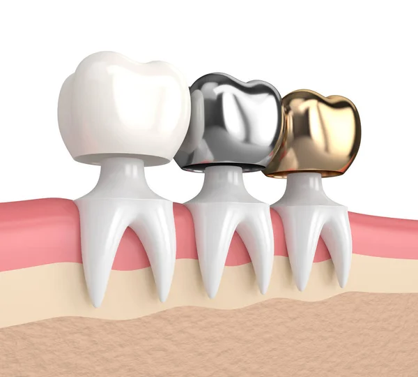 3D візуалізація зубів з різними типами зубної коронки — стокове фото