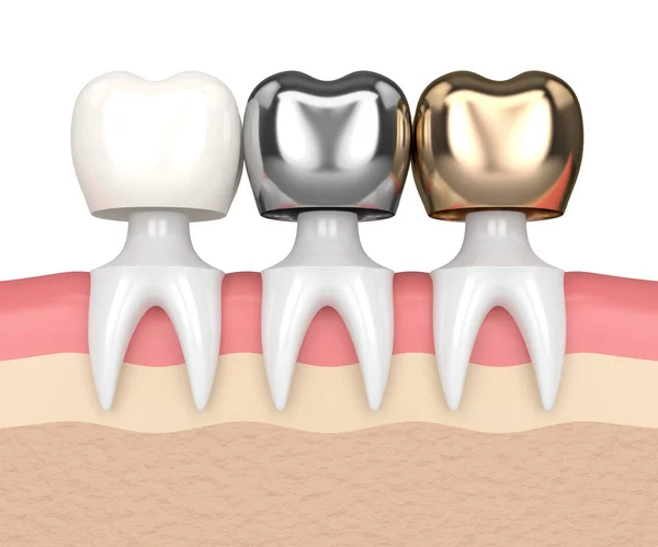 3d render of teeth with different types of dental crown — Stock Photo, Image