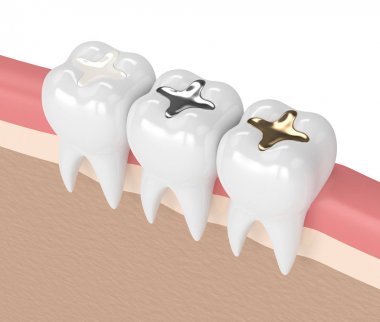 3d render of teeth with different types of dental filling clipart