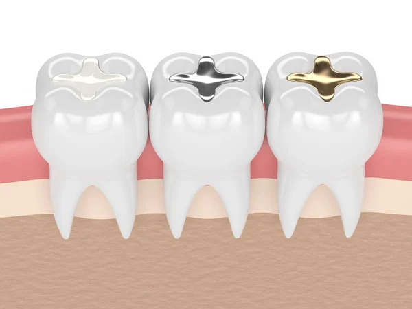 3d render of teeth with different types of dental filling — Stock Photo, Image