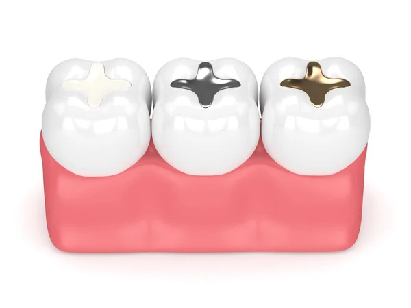 치과 충전의 종류와 치아의 3d 렌더링 — 스톡 사진