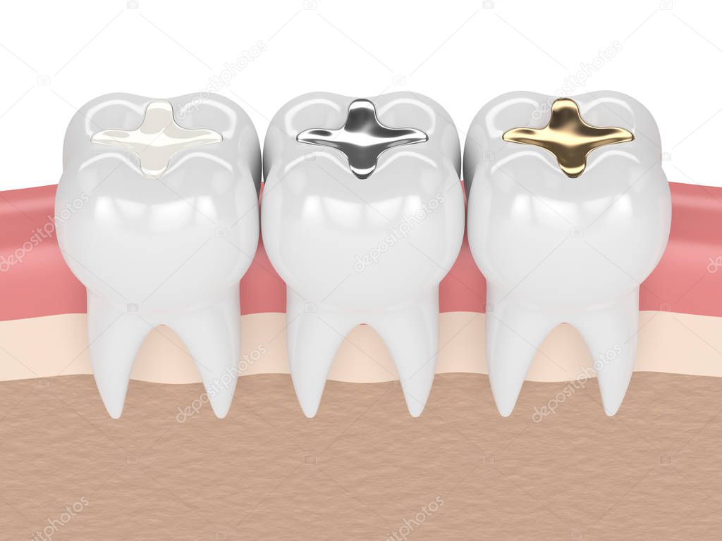 3d render of teeth with different types of dental filling