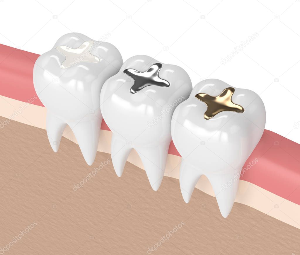 3d render of teeth with different types of dental filling