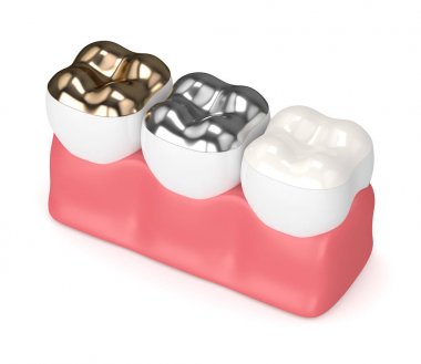 diş diş dolgu farklı tipleri ile 3D render