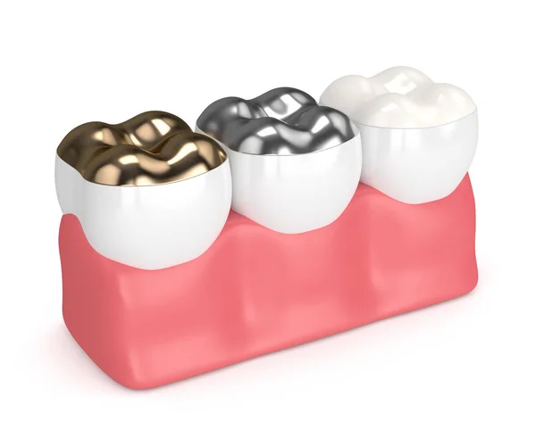 3d 不同类型补牙牙的牙齿呈现 — 图库照片