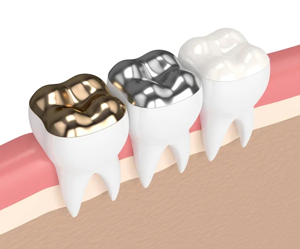 3d render of teeth with different types of dental filling — Stock Photo, Image