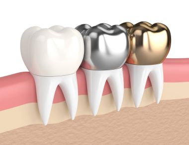 3d render of teeth with different types of dental crown clipart