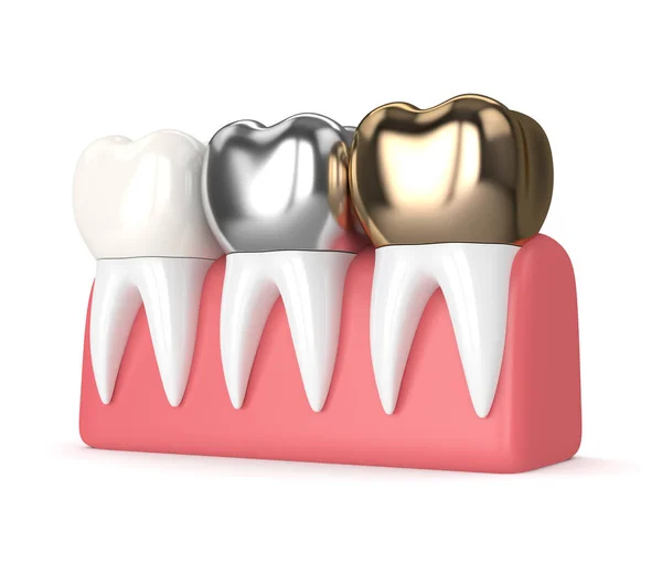 3d render of teeth with different types of dental crown — Stock Photo, Image