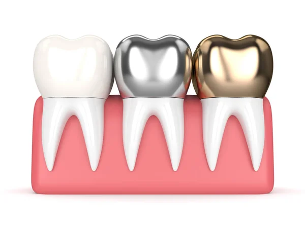 A fogak, a különböző típusú fogászati korona 3D render — Stock Fotó