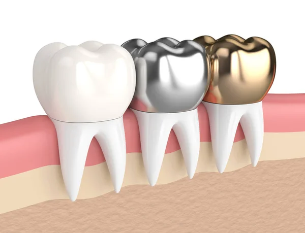 3d rendu des dents avec différents types de couronne dentaire — Photo