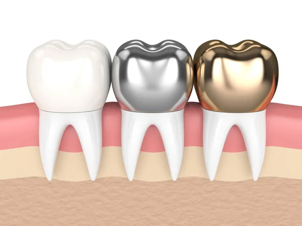 3d render of teeth with different types of dental crown — Stock Photo, Image