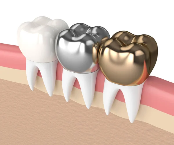 3d render of teeth with different types of dental crown — Stock Photo, Image