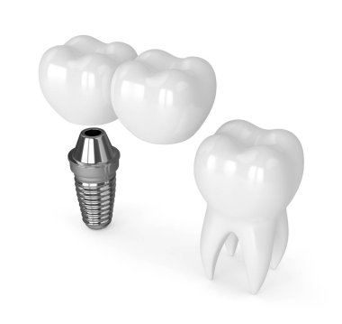 implant diş köprü prensibine göre ile 3D render 