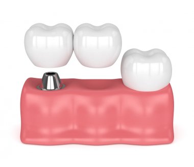 implant diş köprü prensibine göre ile 3D render 