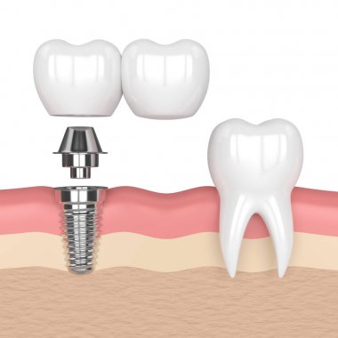 implant diş köprü prensibine göre ile 3D render 