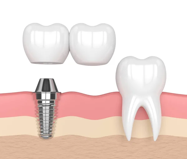 3D render van implantaat met tandheelkundige cantilever bridge — Stockfoto