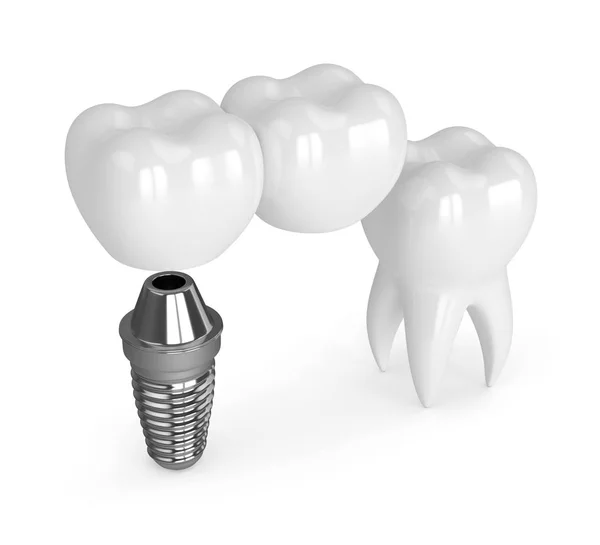 3D renderizado de implante con puente en voladizo dental — Foto de Stock