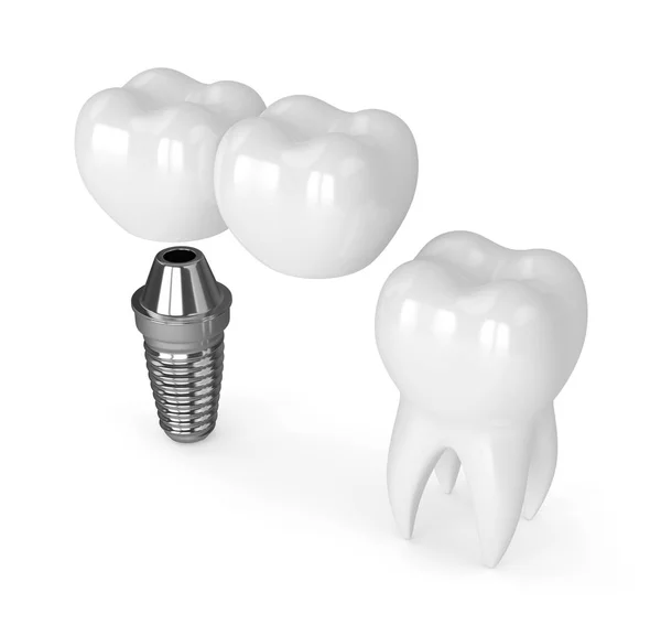 3D render implantu z dentystyczne mostu wspornikowego — Zdjęcie stockowe