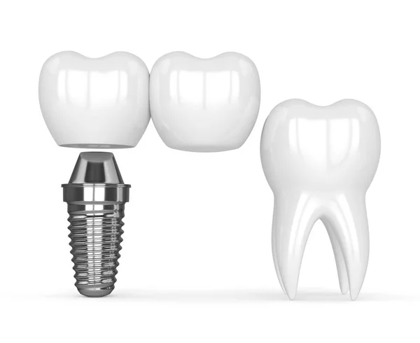 3D render implantátum, fogászati konzolos híd — Stock Fotó