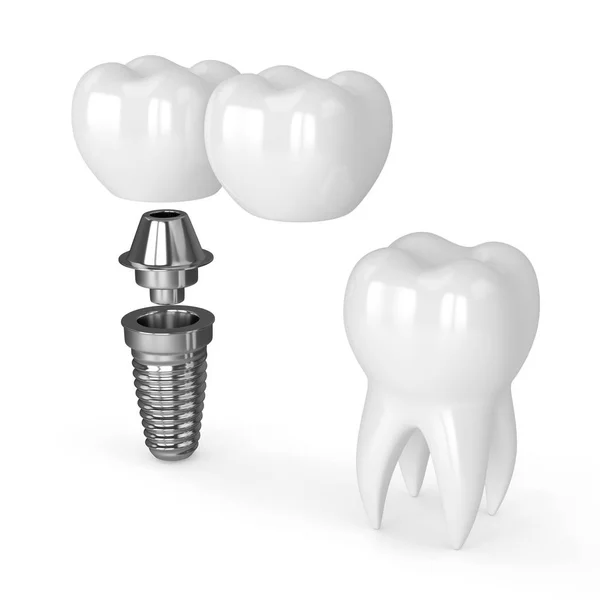 3d render of implant with dental cantilever bridge — Stock Photo, Image