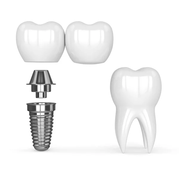 3d render of implant with dental cantilever bridge — Stock Photo, Image