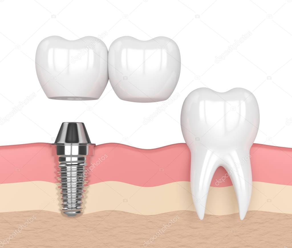 3d render of implant with dental cantilever bridge 