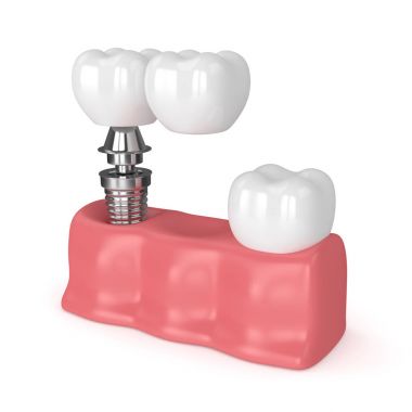 implant diş köprü prensibine göre ile 3D render 