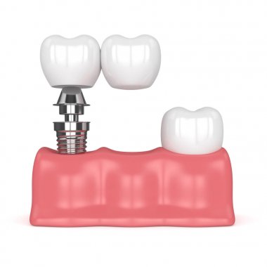 implant diş köprü prensibine göre ile 3D render 